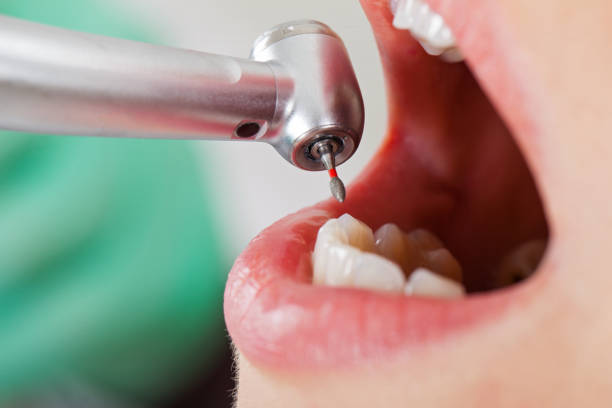Best Dental Abscess Treatment in Leadwood, MO